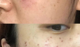 激光祛斑视频全过程,安全高效，美丽蜕变