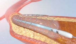 心脏支架手术视频,技术革新与患者康复之路